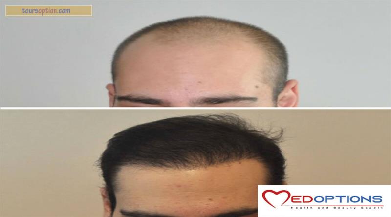 Before After