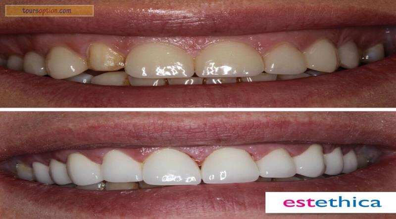 Teeth Before After