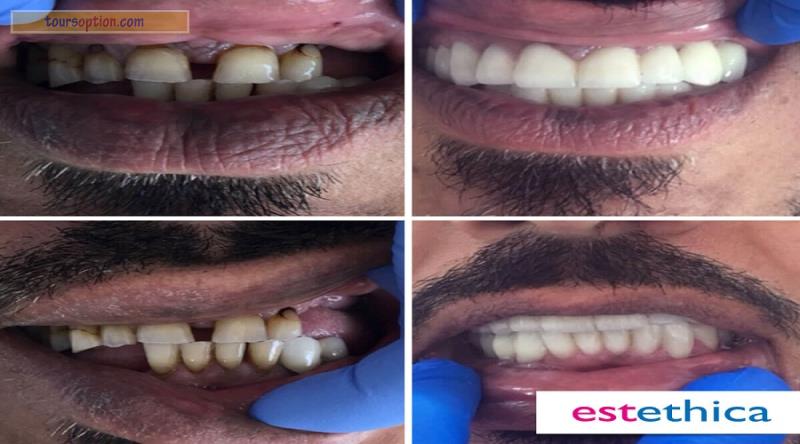 Teeth Before After