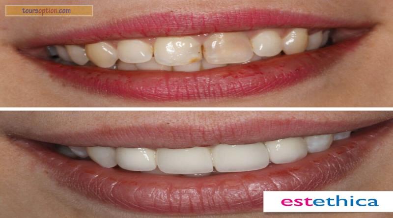 Teeth Before After