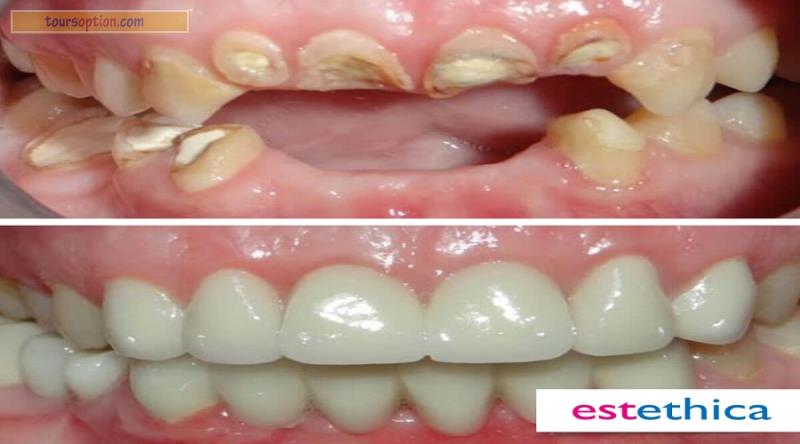 Teeth Before After