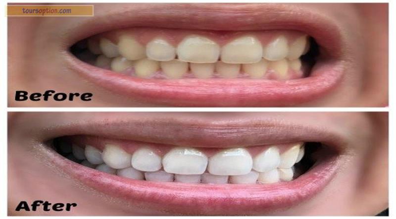 Teeth Whitening Before And After