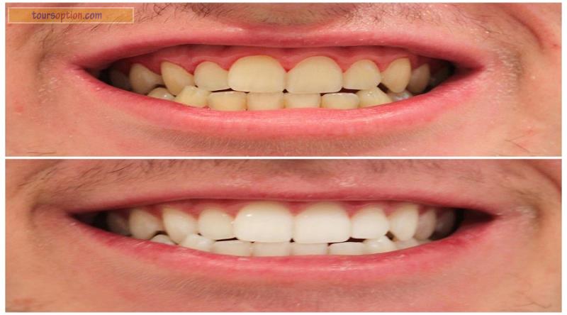 Teeth Whitening Before And After